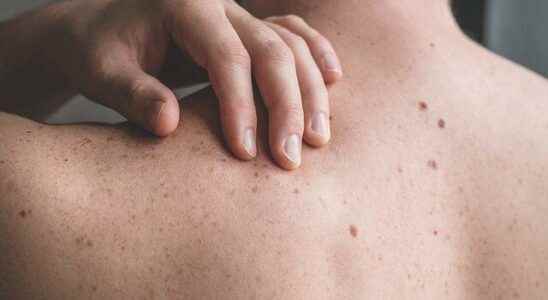 Experts warn Pay attention to the appearance of your moles