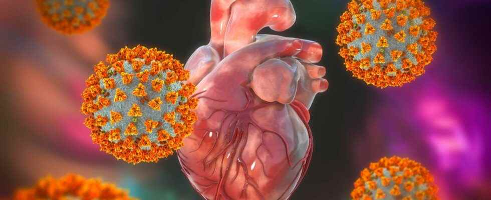 Fulminant myocarditis and Sars CoV 2 researchers highlight two distinct profiles