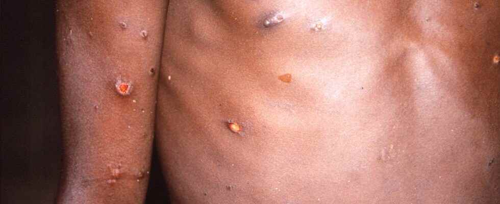 It is not excluded that monkeypox will become more contagious