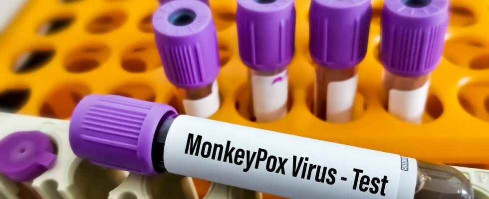 Monkey pox the HAS is in favor of the reimbursement