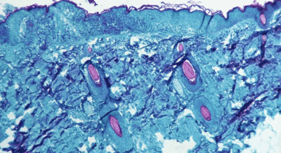 Monkeypox and vaccination The problem is the distribution of doses