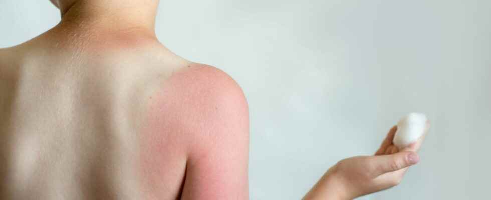 Sunburn in children solutions Biafine what age