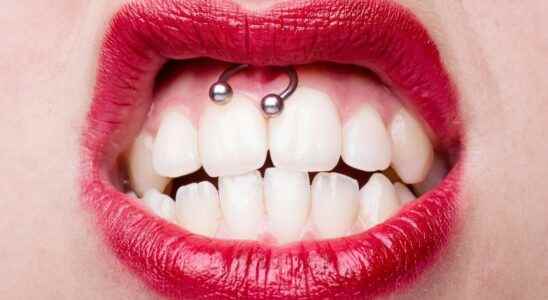 The smiley piercing does not make orthodontists laugh