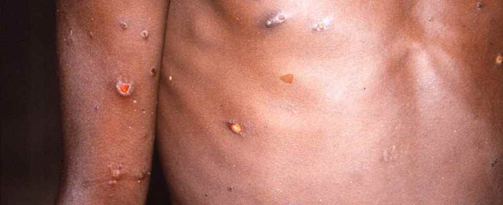 Two small children infected with monkeypox in the United States