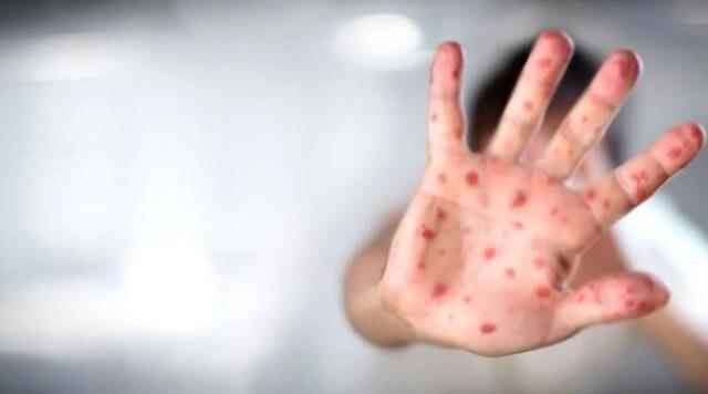 What are the symptoms of Monkey Pox Does Monkey