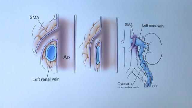 findikkiran-syndrome-14-years-after-occurring-patient-surgery-sagligina-kavustu_5702_dhaphoto4