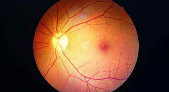 Diabetic retinopathy what is it