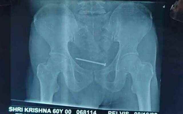 Doctors are stunned 10 cm rusty nail came out