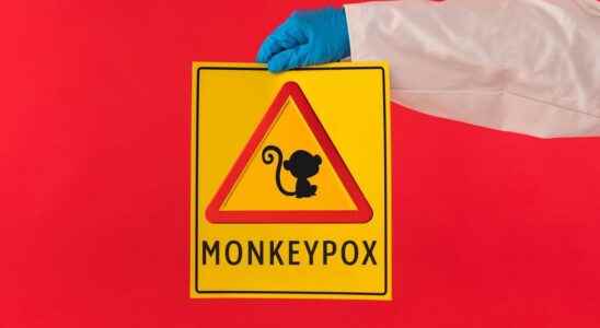 Monkey pox a second infected patient dies in Spain