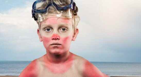 Natural sunburn remedies waiting in the fridge