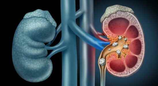 Solve the kidney stone problem with the recipe of Ibn