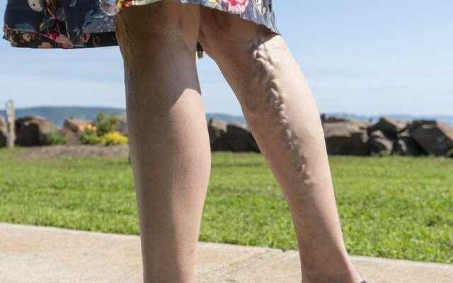 Things to consider to avoid varicose veins