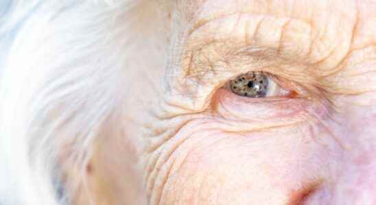 AMD a protein responsible for age related vision loss