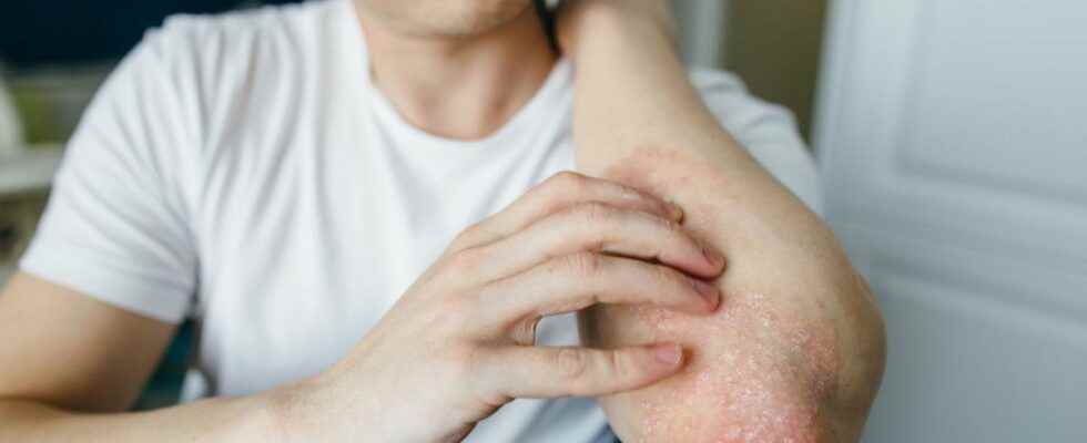 Atopic eczema one in three patients finds no treatment that