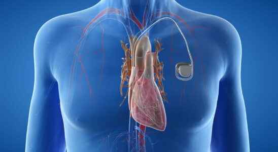 Failing Abbott pacemaker list models what to do