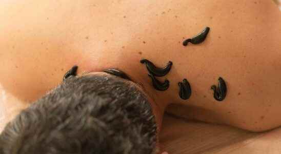 Life risk in leech therapy One of the biggest problems