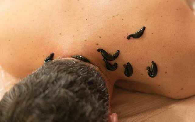 Life risk in leech therapy One of the biggest problems