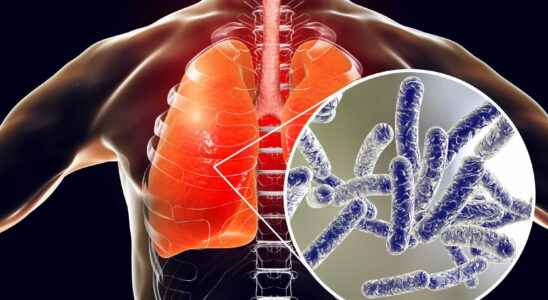 Pneumonia in Argentina legionellosis in question