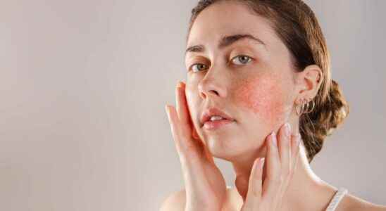 Rosacea and couperose how to get rid of them