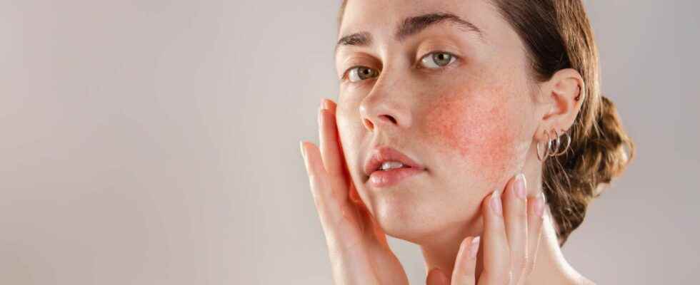 Rosacea and couperose how to get rid of them