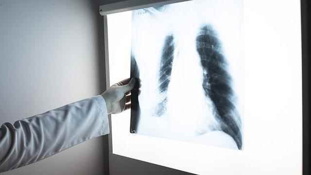 Annoying statement from the World Health Organization Tuberculosis cases on