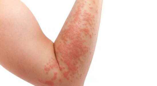 Eczema may not be as bad as you think May