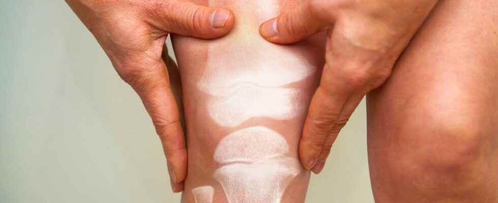 Osteoarthritis low weight gain increases the risk of knee prosthesis