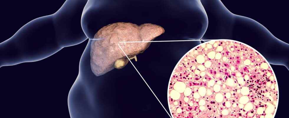 NASH fatty liver symptoms what is soda disease