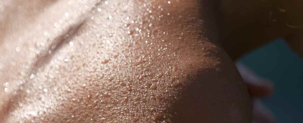 Sweat allergy signs can it be treated