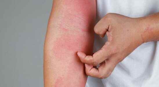 Triggers skin diseases Health News