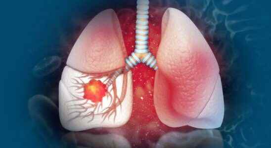 You can lower your risk of lung cancer by taking