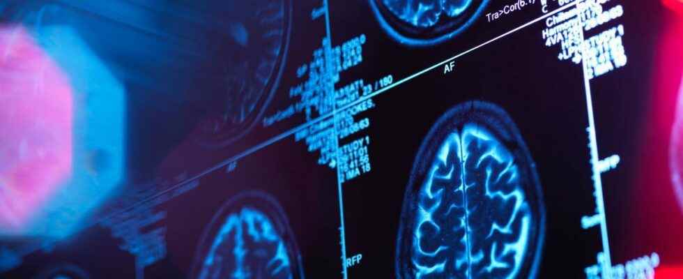 Against Alzheimers Lecanemab confirms its promising results