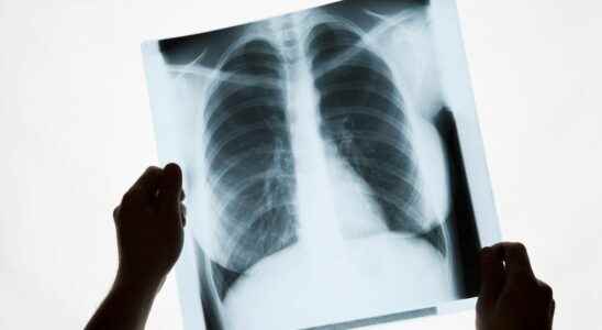 Artificial intelligence predicts cardiovascular risk using a simple chest X ray