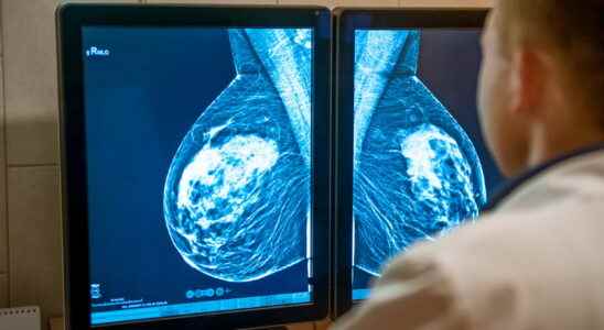 Breast calcifications pain causes benign