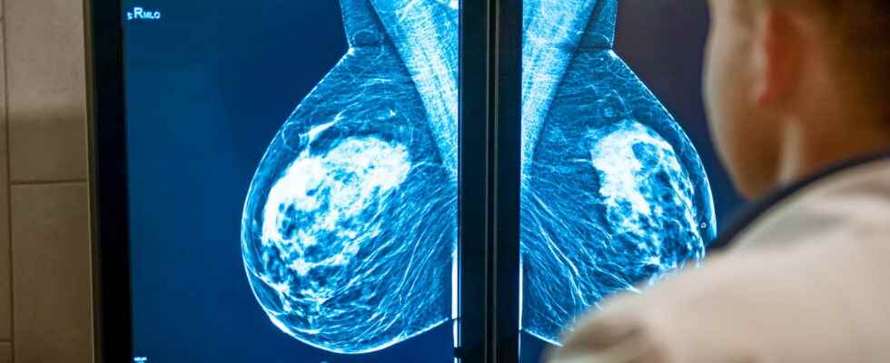 Breast calcifications pain causes benign