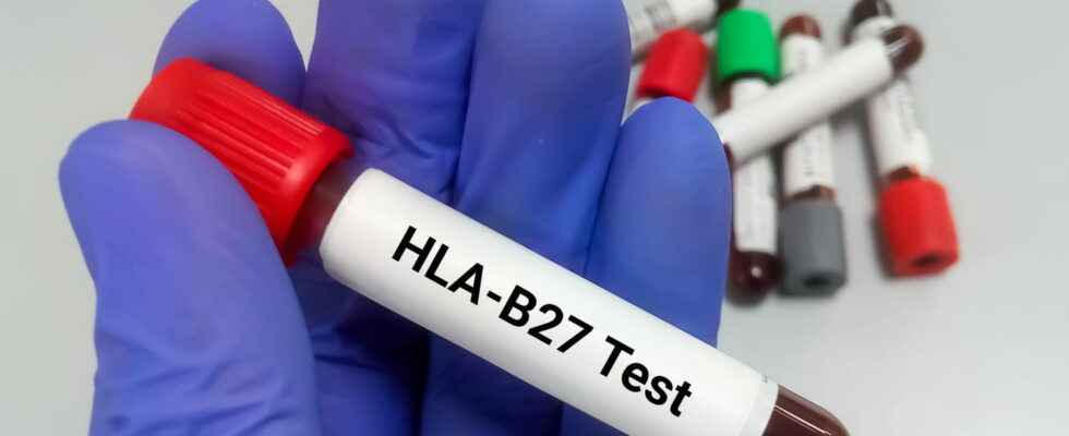 HLA B27 antigen transmission when to look for it