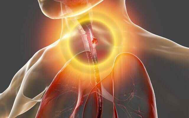 It is the first sign of esophageal cancer See your