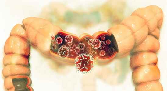 Lieberkuhnian adenocarcinoma symptoms prognosis