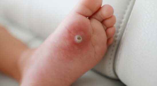 The simplest treatment method for warts on the soles of