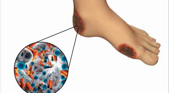 Gangrene signs of necrosis causes treatments