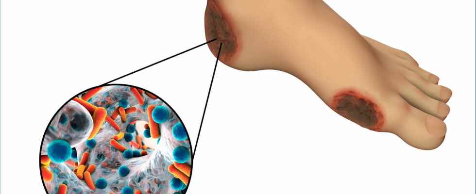 Gangrene signs of necrosis causes treatments