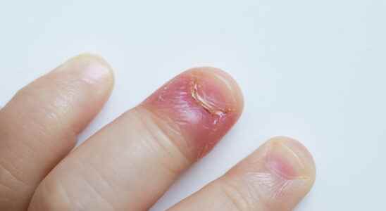 Paronychia what it looks like dermatologist advice