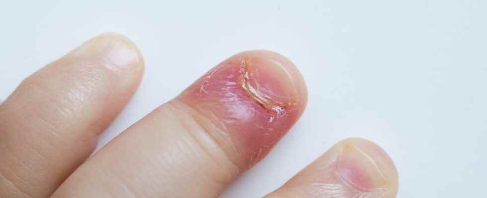 Paronychia what it looks like dermatologist advice