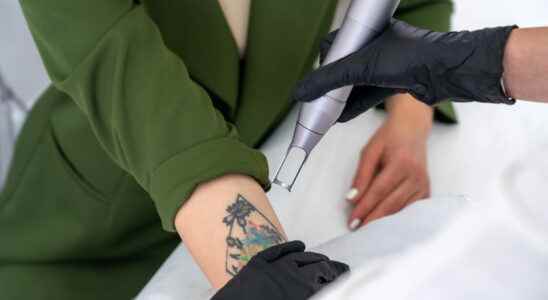 Removing a tattoo how pain risk