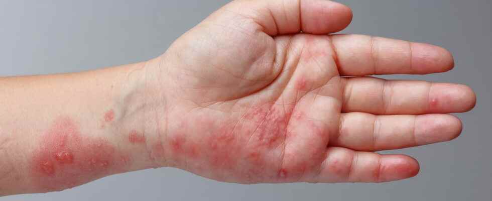 Shingles symptoms photo of pimples contagious