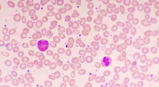 Thrombocytosis cause assessment is it serious