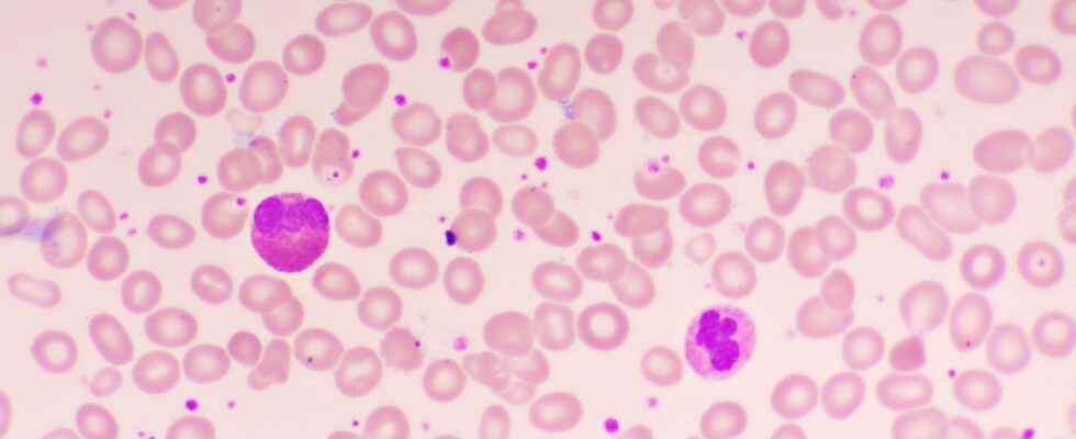 Thrombocytosis cause assessment is it serious