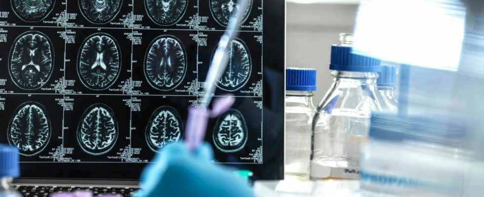 Alzheimers towards a promising drug