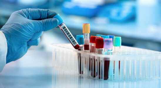 Coombs test direct indirect positive negative