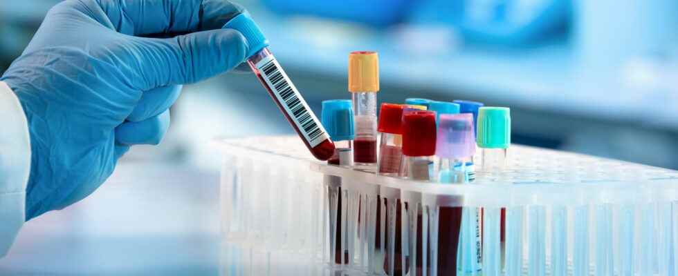 Coombs test direct indirect positive negative